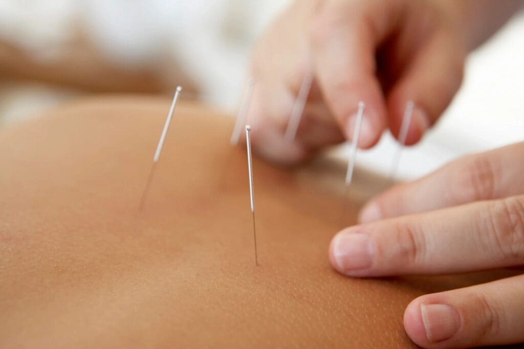 Close-up of acupuncture needles inserted into a person's back, with hands adjusting the needles.